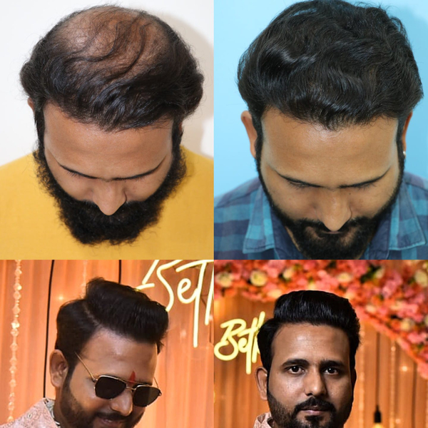 Cover photo of Supermax Hair Transplant – Best FUE & DHI Clinic in Rohini, Delhi | Hair Transplant Cost in India – PRP Injection